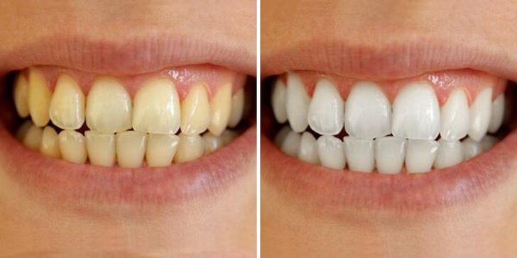 Důkladná dentální hygiena s air flow i bez pro zářivý úsměv