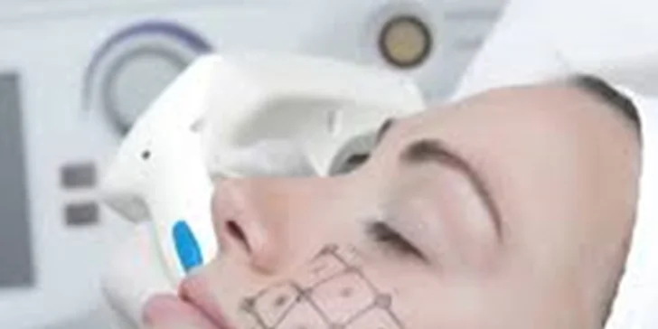 Lifting Thermage CPT–omlazení celého obličeje