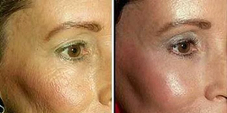 Lifting Thermage CPT–omlazení celého obličeje