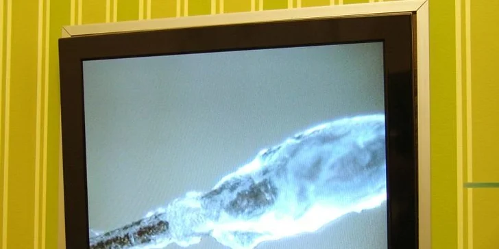 Ošetření pokožky hlavy technologií Kapyderm
