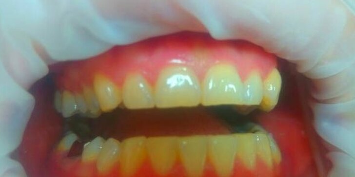Dentální hygiena a bělení zubů gelem a modrým laserovým světlem
