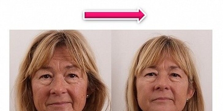 Modelace kontur - zpevnění - lifting obličeje a krku