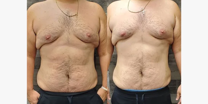 Výsledek ošetření po 5 aplikacích ultrazvukové liposukce u muže
