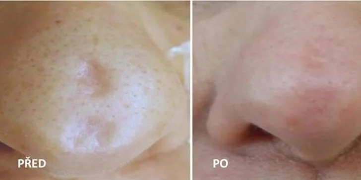 Kamufláž jizev: permanentní make-up nedokonalostí pleti
