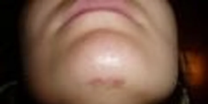 Kamufláž jizev: permanentní make-up nedokonalostí pleti