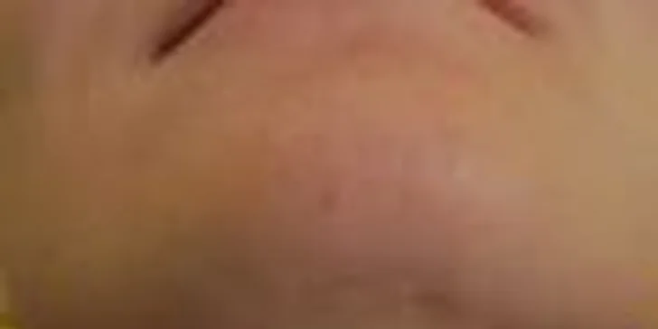 Kamufláž jizev: permanentní make-up nedokonalostí pleti
