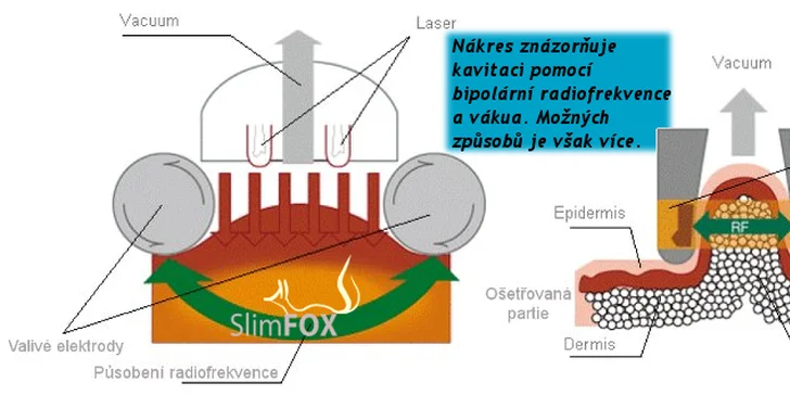 Masáž pomocí kavitačního přístroje Be Beauty 2205