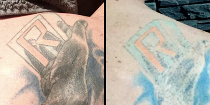 Odstranění tetování Q-switch laserem v profi studiu: udělejte si místo na nový kus