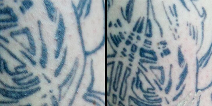 Některé chyby lze vzít zpět: odstranění tetování Qswitch laserem v profi studiu