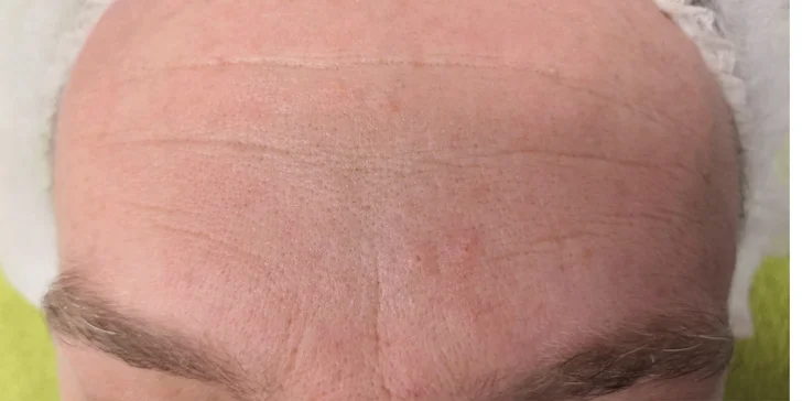 Pleť pred a po ošetrení microneedlingom