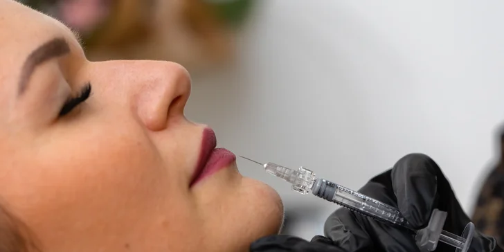 Russian lips: Výplň a modelácia pier kyselinou hyalurónovou