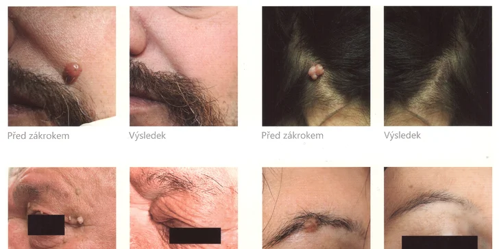 K odstranění se používá vysoce výkonný italský přístroj K-laser, který přináší naprosto bezkonkurenční výsledky.