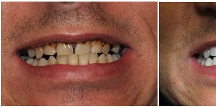 Důkladná péče o váš chrup: dentální hygiena a případně i ordinační bělení