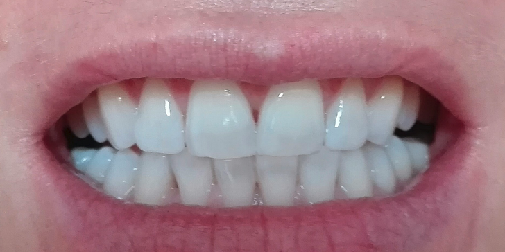 Kosmetické šetrné neperoxidové zesvětlení zubů