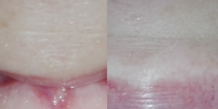 Kosmetické šetrné neperoxidové zesvětlení zubů