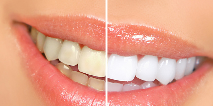 Šetrné zesvětlení zubů bez peroxidu přístrojem Dentalux