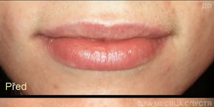 Mikropigmentace obočí (vláskování) nebo rtů včetně probarvení