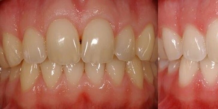 Luxusní bělení zubů bez peroxidu - okamžitý účinek