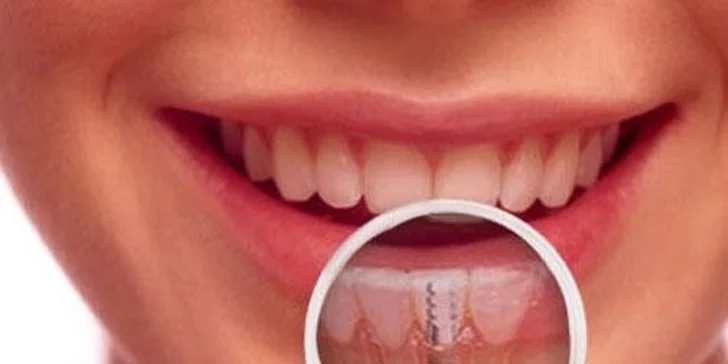 Implantát je neviditelný a korunka je téměř k nerozeznání od pravých zubů. 