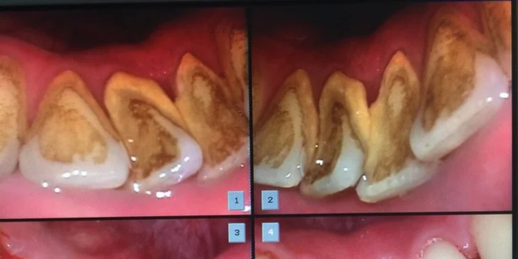 Dentální hygiena pro zářivý úsměv