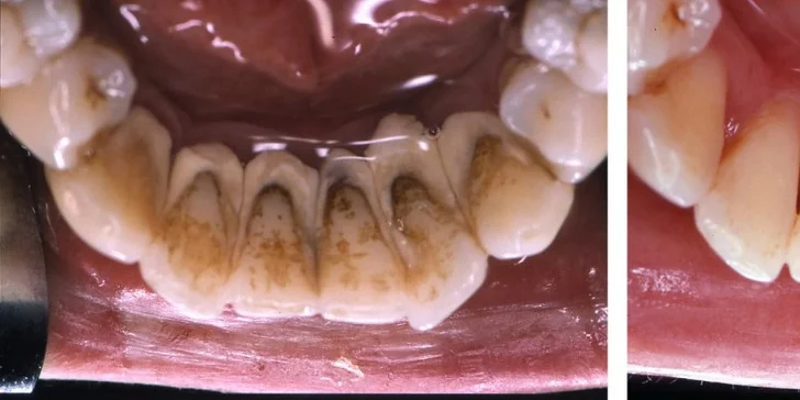 Dentální hygiena pro zářivý úsměv