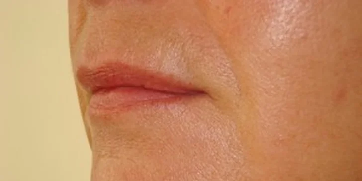 Omládněte o pár let: vypnutí pleti plazmovými toky nebo lifting