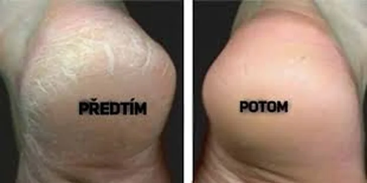 Zbavte se plísně na nohou a nehtech: speciální ošetřující pedikúra