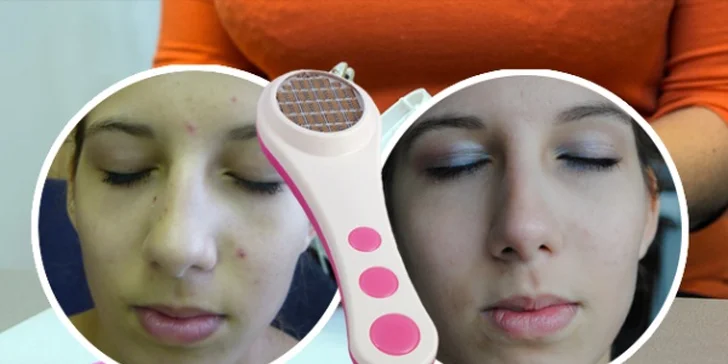 Kosmetické ošetření proti vráskám a akné přístrojem Face-Up