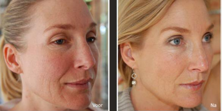 Ošetření obličeje pomocí mezoterapie a zapracování kolagenu