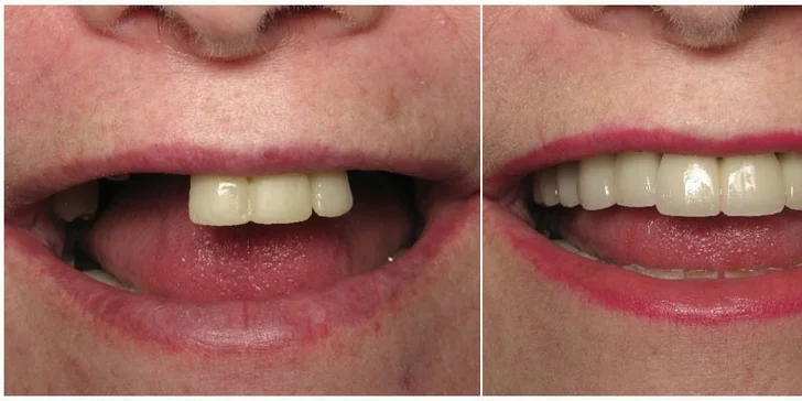 Implantaci budou provádět zkušení stoma­tochirurgové s mno­haletou praxí.  Zákrok trvá cca 30–60 min. a provádí se v lokální anestezii, je tedy zcela bezbolestný.