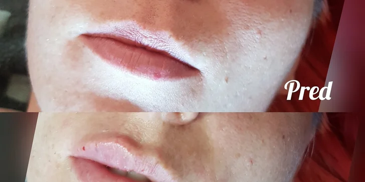 Vďaka metóde Russian lips získajú vaše pery žiadúci tvar srdca
