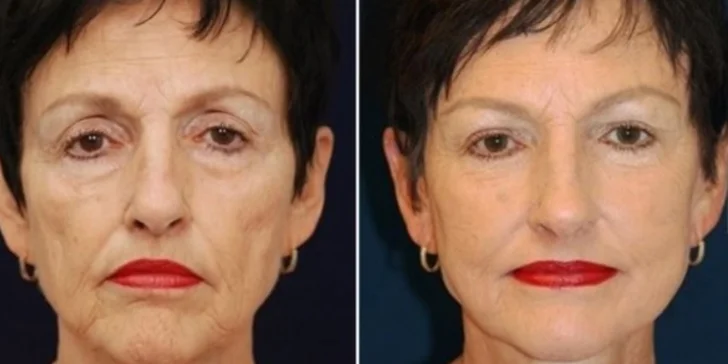 výsledek po 6 měsících po celoobličejovém faceliftingu