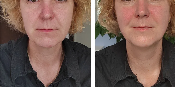 Pro ty, kteří hledají maximální efekt v krátkém čase, je ideální volbou bukální masáž s laserovým ošetřením a intenzivní péčí. 