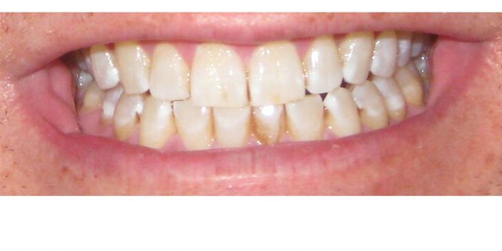 Zuby jako perličky: ordinační bělení zubů studeným modrým světlem