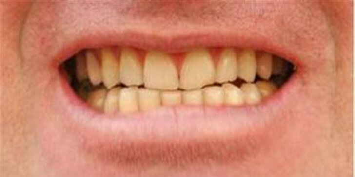Zuby jako perličky: laserové bělení zubů studeným modrým světlem
