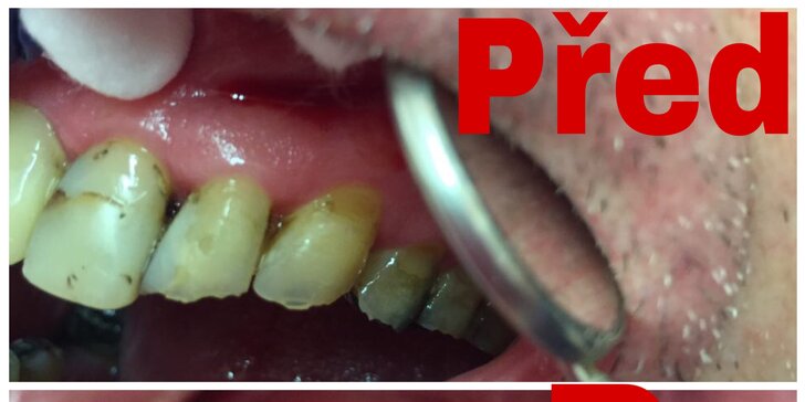 Dejte si spravit zub fotokompozitní plombou z nejkvalitnějšího materiálu