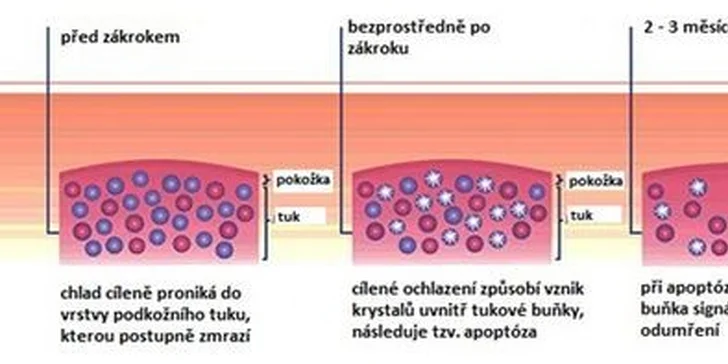 Hubnoucí balíček. Kryolipolýza a radiofrekvence