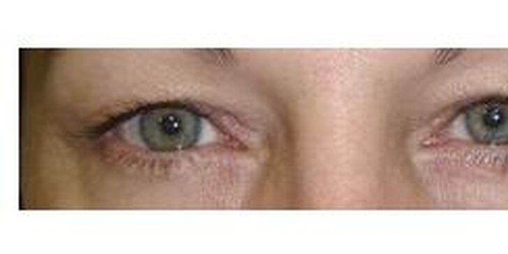 Pryč s přebytečnou kůží: rezervační poplatek na operaci očních víček