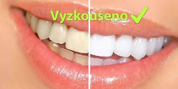 Zářivý úsměv snadno a šetrně: neperoxidové bělení zubů