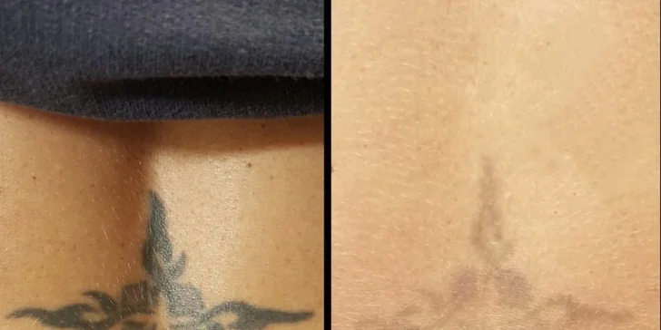 Zlé rozhodnutia nemusia ostať vpísané vo vašej koži po celý život
