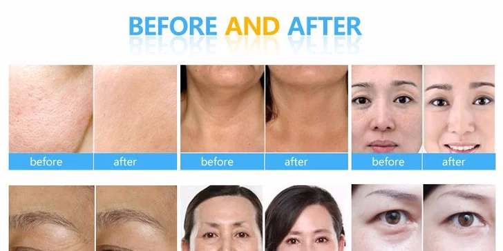 Hydrodermabraze: čištění, peeling a hydratace pleti v jednom