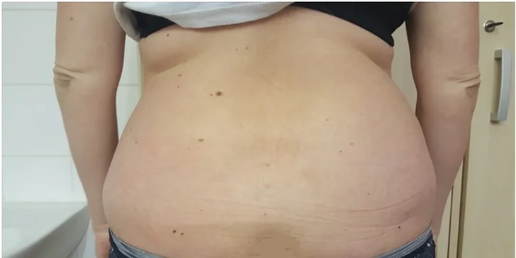 Hubněte kombinací ultrazvuku a radiofrekvence: přístroj HIFU UltraShape V4