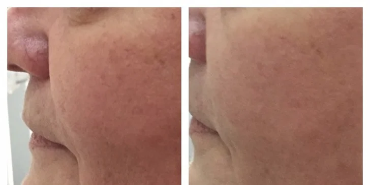Pred a ihneď po ošetrení zákazníčky v Lumines beauty centre.