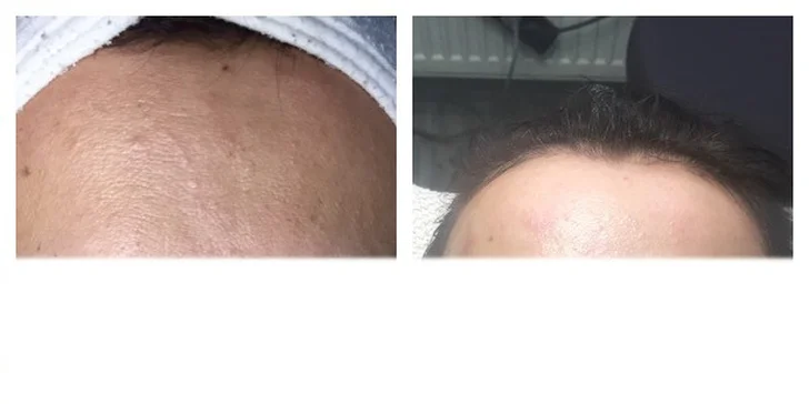 Pred a ihneď po ošetrení zákazníčky v Lumines beauty centre.