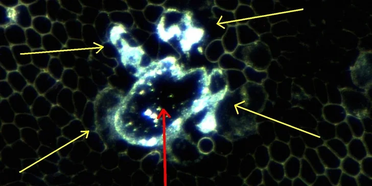 Chemotaktický symplast s těžkými kovy kolem 4 leukocyty (bílé krvinky)