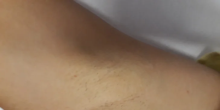 Zbavte se chloupků! Permanentka na laserovou epilaci partie dle výběru.