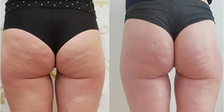 Lymfomodeling stimuluje tok lymfy a pomáhá tak organismu s detoxikací a regenerací.