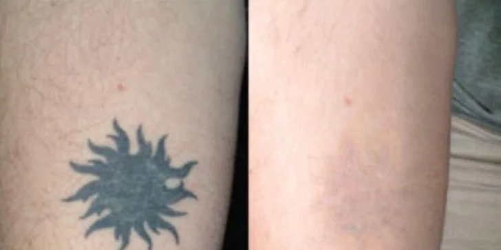 Pomocou výkonného lasera sa môžete zbaviť nežiadúceho tetovania aj permanentného make-upu