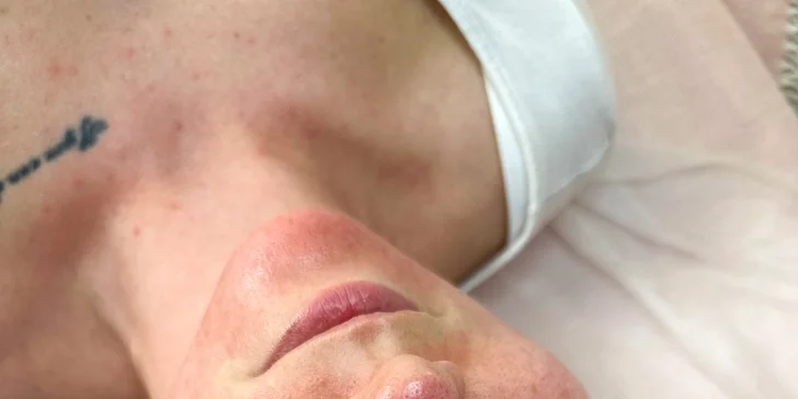 V ponuke nájdete obľúbené ošetrenia Microneedling, BB Glow a Glass Skin. 