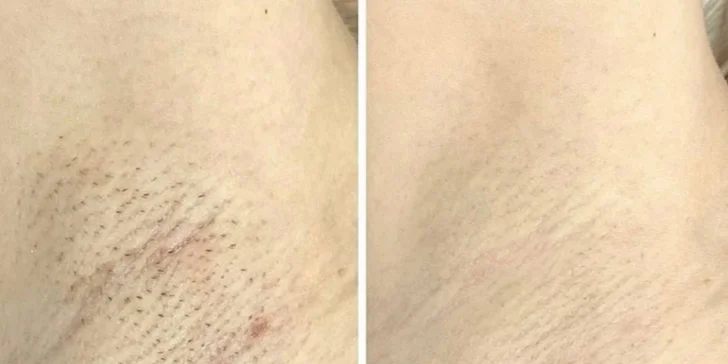 Epilácia podpazušia trvá len 20 až 30 minút, čo z nej robí ideálnu procedúru aj počas obednej prestávky.